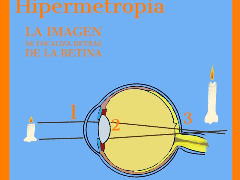 Hipermetropia. Cuando ver de cerca se vuelve un&nbsp;desafio.